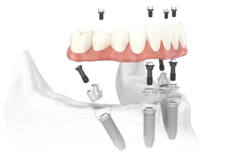 Dental Implants vs Conventional Dentures – The Pros And Cons Discussed