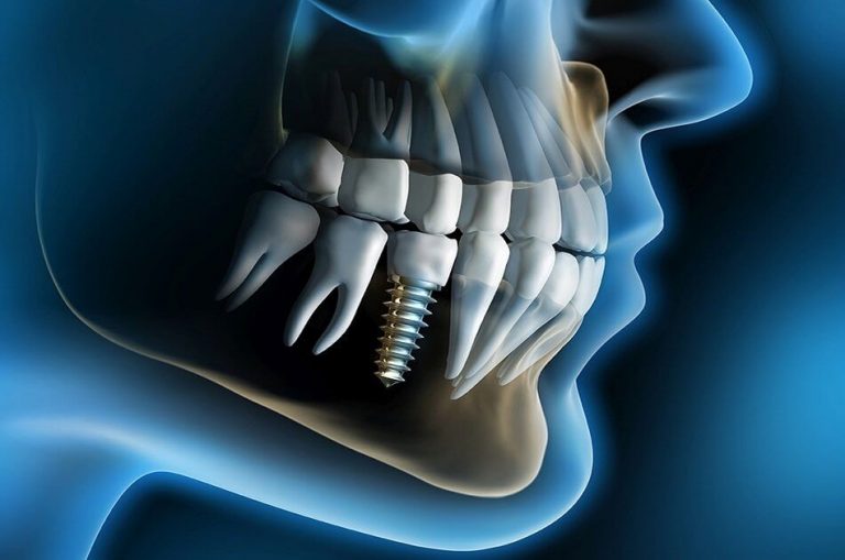 New Dental Breakthrough All-on-four